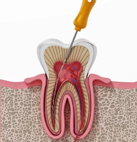 Endodoncia en Graus