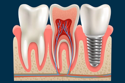 Implantes Dentales Dr Antonio Vidal